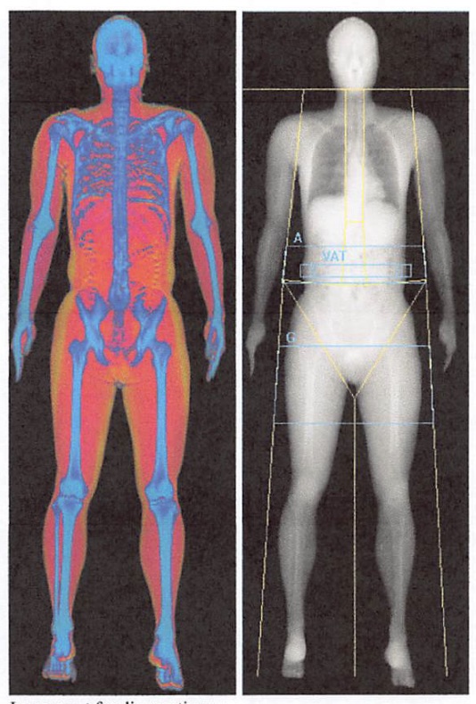 Insulin resistance - a silent epidemic pt. 2